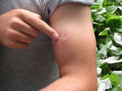Person with Mosquito bite